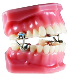 MARA appliance (Mandibular Anterior Repositioning Appliance) 