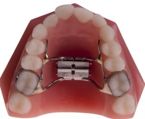 Palatal Expander